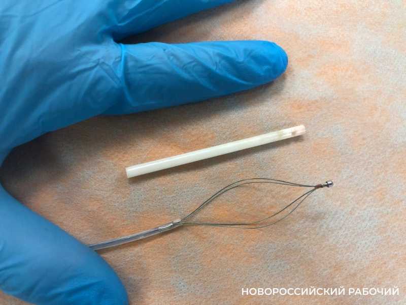 В Новороссийске из желудка девочки вытащили палочку от леденца