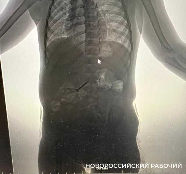 В Новороссийске из желудка 2-летней девочки вытащили саморез